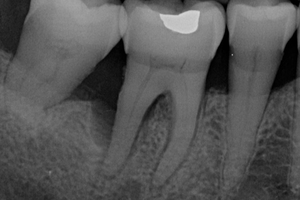 Studio Dentistico Gerboni - Fattori di rischio della malattia parodontale