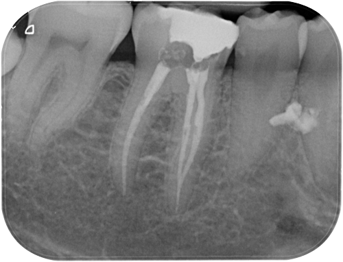 Studio Dentistico Gerboni Endodonzia 01
