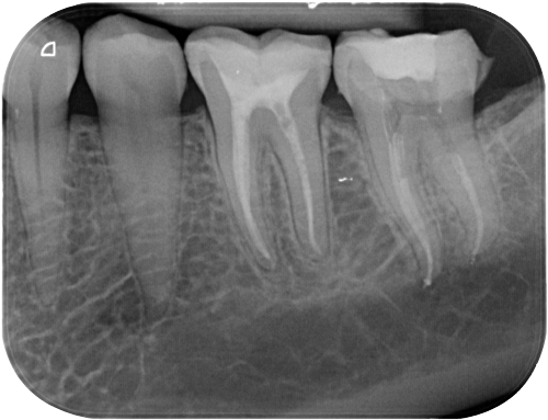 Studio Dentistico Gerboni Endodonzia 02
