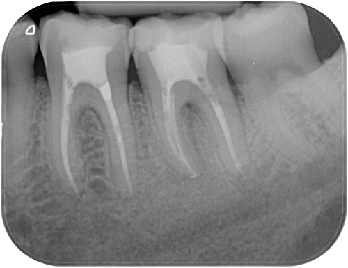 Studio Dentistico Gerboni Endodonzia 03