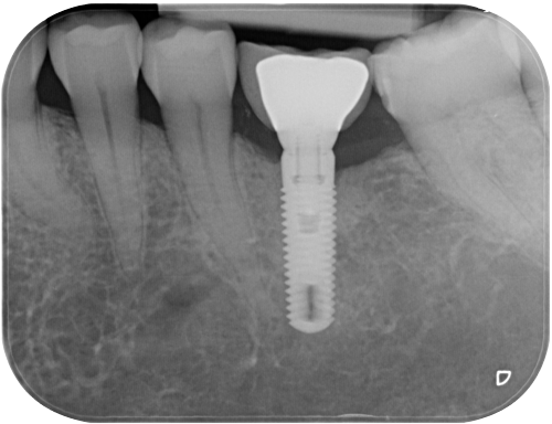 Studio Dentistico Gerboni Implantologia 02